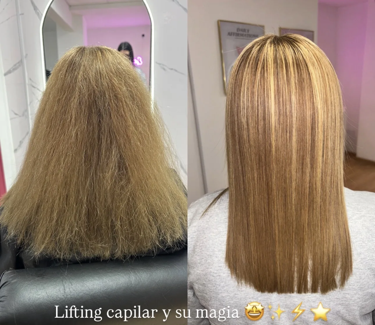 Resultado de lifting capilar